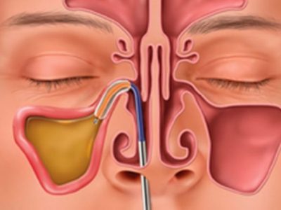 Need Relief From Your Sinuses? See a&nbsp;Specialist!