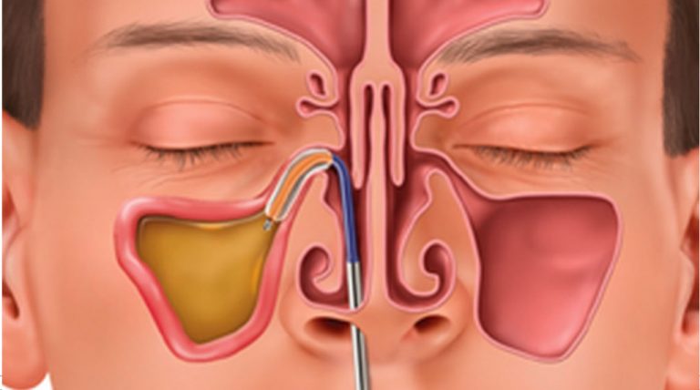 Need Relief From Your Sinuses? See a&nbsp;Specialist!